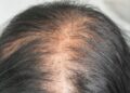Baldness