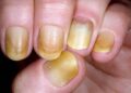 Yellow Nail Syndrome : पिवळी नखे शरीरातील काही आजारांचे संकेत देतात, त्याकडे दुर्लक्ष करू नका