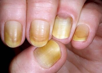 Yellow Nail Syndrome : पिवळी नखे शरीरातील काही आजारांचे संकेत देतात, त्याकडे दुर्लक्ष करू नका