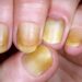Yellow Nail Syndrome : पिवळी नखे शरीरातील काही आजारांचे संकेत देतात, त्याकडे दुर्लक्ष करू नका