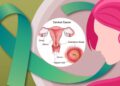 Cervical Cancer